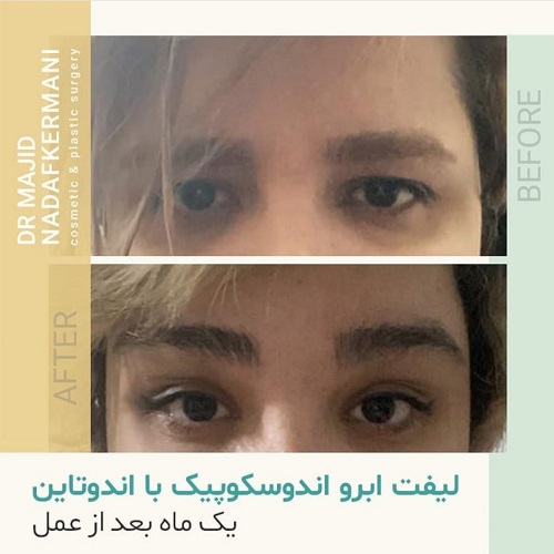 لیفت شقیقه چه تفاوتی با لیفت ابرو یا پیشانی دارد؟