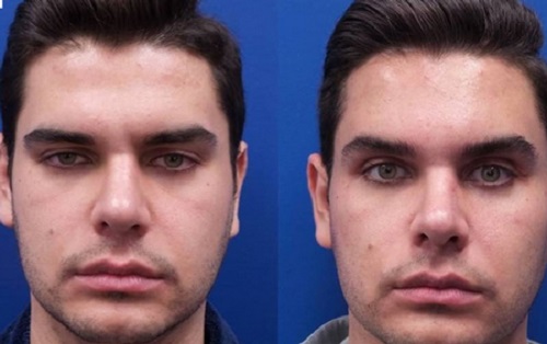 ۸ توصیه برای بوتاکس اولیها