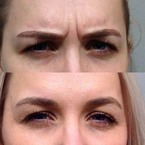 ۸ توصیه برای بوتاکس اولیها