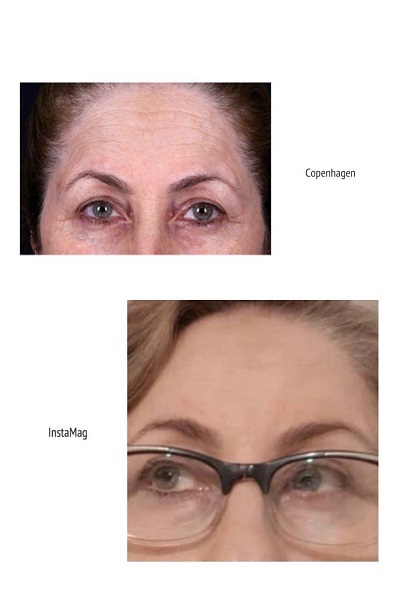 ۸ توصیه برای بوتاکس اولیها