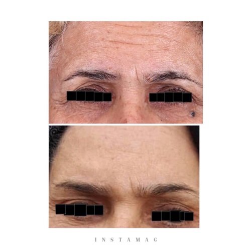 ۸ توصیه برای بوتاکس اولیها