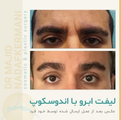 لیفت شقیقه با بوتاکس