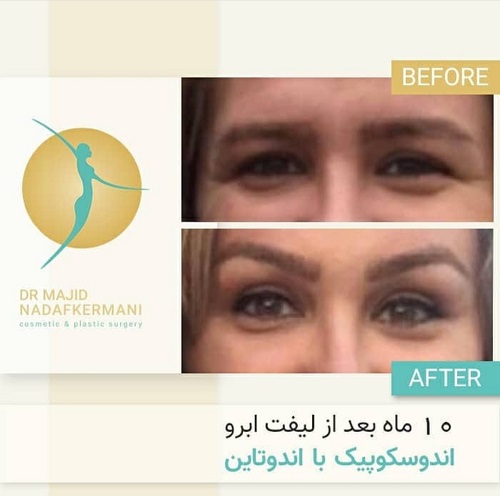 مراقبت‌های بعد از انجام لیفت شقیقه