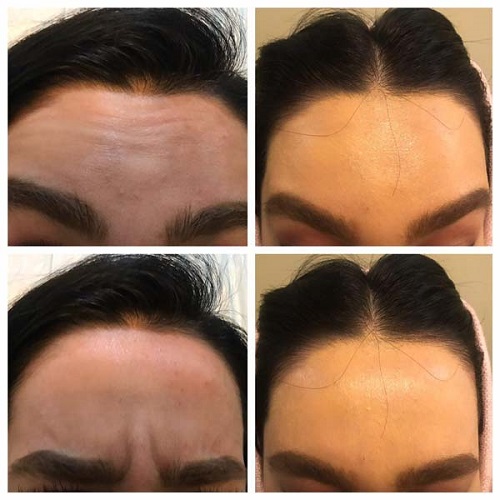 ۸ توصیه برای بوتاکس اولیها