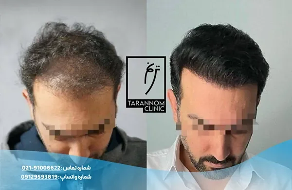 hair-transplant-portfolio-2