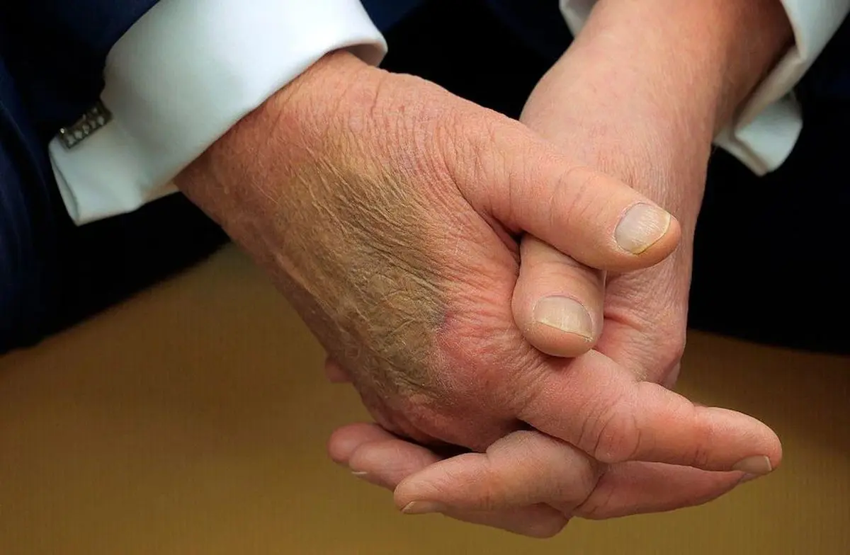 جدال داغ بر سر سلامتی ترامپ؛ واقعیت خستگی یا بازی رسانه‌ای؟