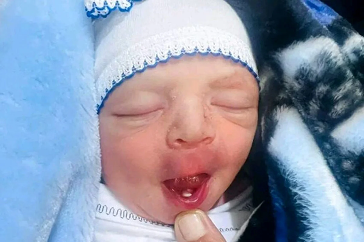 نوزادی در بابل با دندان شیری متولد شد؛ ماجرای شگفت‌انگیز کشیدن دندان در اولین روزهای زندگی!