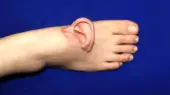 شگفتی پزشکی: اولین پیوند موفق گوش به پا در بیمارستان جینان!