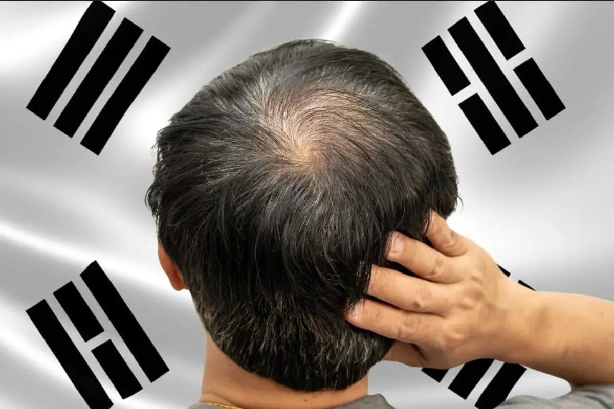 رئیس‌جمهور کره‌جنوبی جنگی جدی علیه کچلی به پا کرد؛ درمان ریزش مو زیر ذره‌بین بیمه!