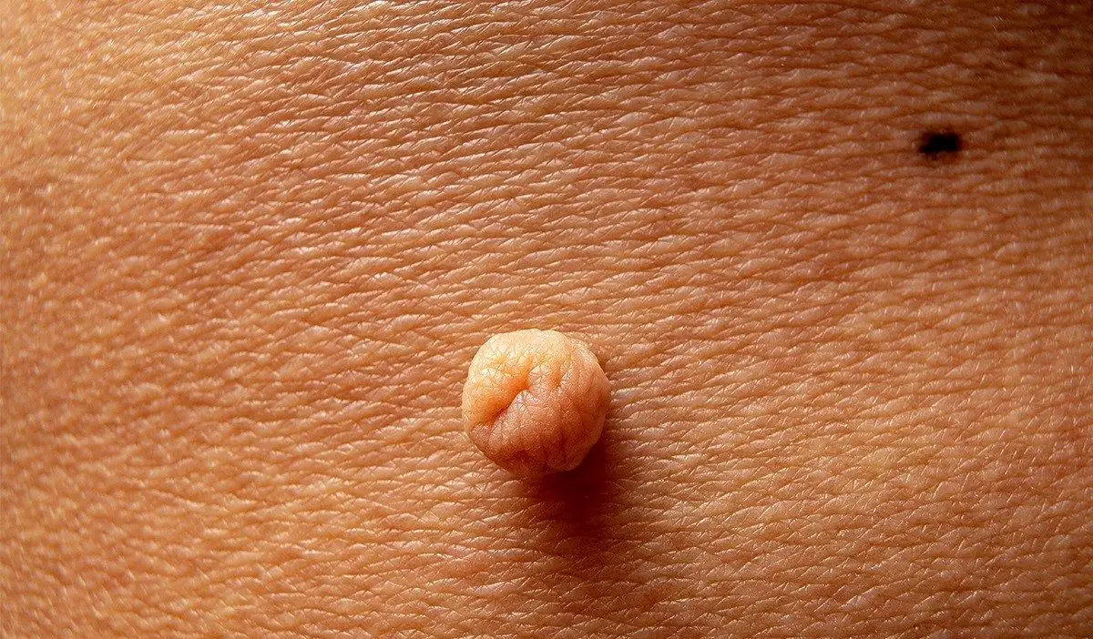 ویژگی های خال گوشتی