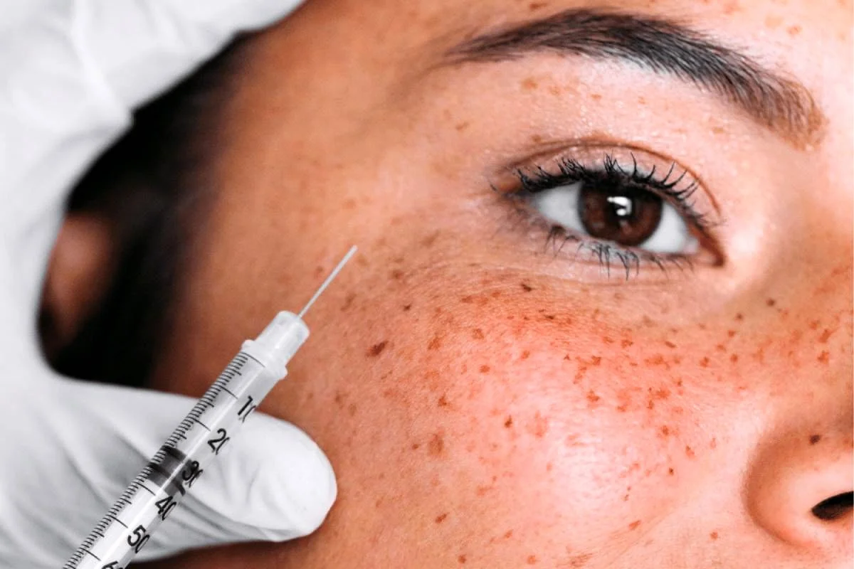 درمان پی آر اف PRF چگونه باعث جوانسازی پوست می‌شود؟