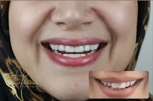 مزایای لمینت دندان از دید بهترین دکتر لمینت دندان در تهران