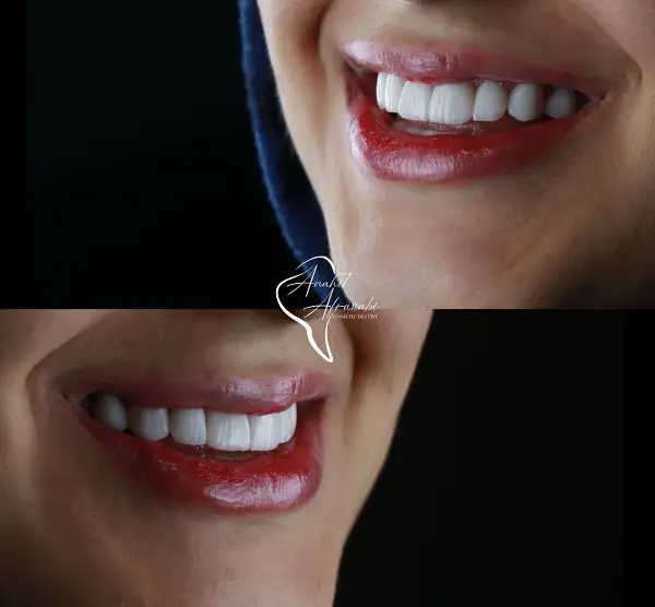 روش کار بهترین دکتر لمینت دندان در تهران