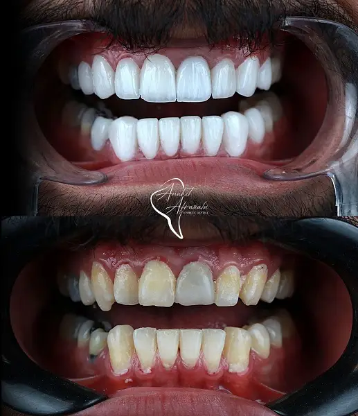 ویژگی های بهترین دکتر لمینت در تهران