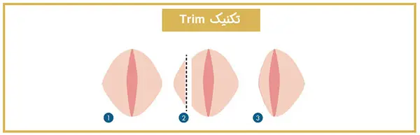 لابیاپلاستی به روش تریم (Trim)