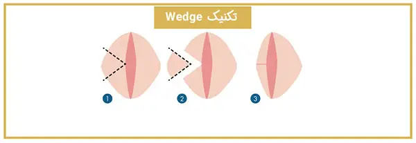 لابیاپلاستی به روش وج ( Wedge )