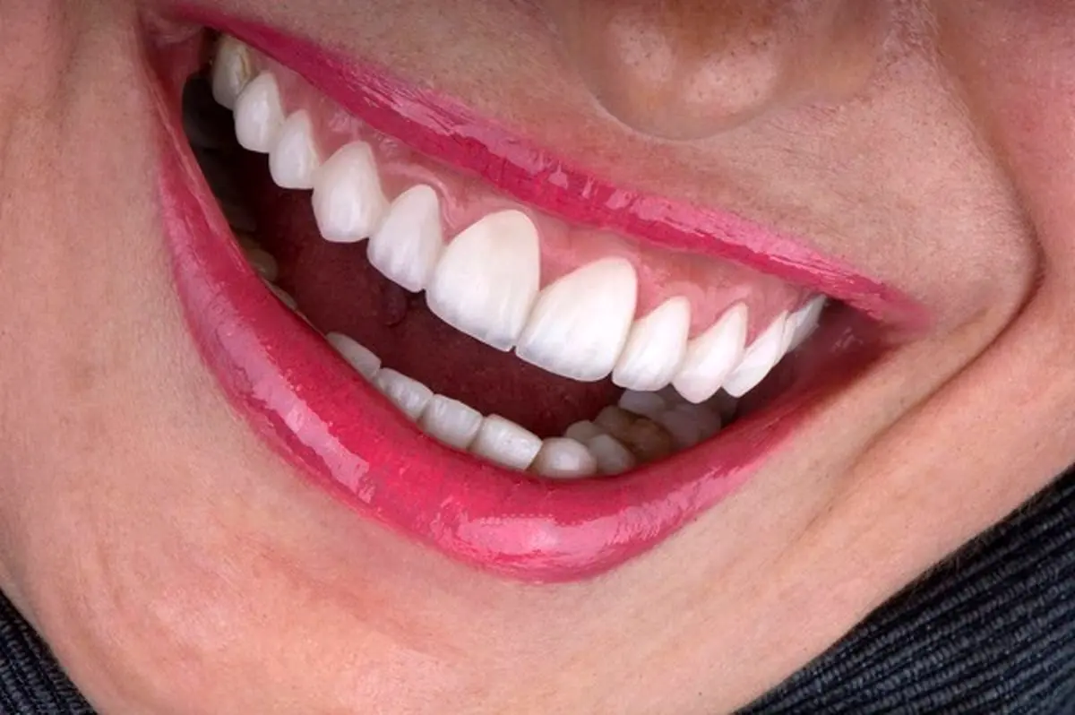 لمینت دندان اقساطی؛ راهکار طلایی برای داشتن لبخندی بی‌نقص بدون فشار مالی!