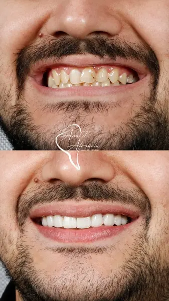 بهترین دکتر لمینت دندان در تهران کیست؟ + معرفی 10 دکتر برتر