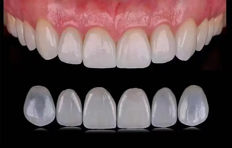 مراحل لمینت دندان به صورت اقساطی