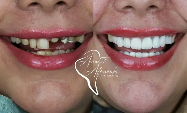 مشاوره با بهترین دکتر لمینت دندان در تهران چگونه انجام می‌شود؟