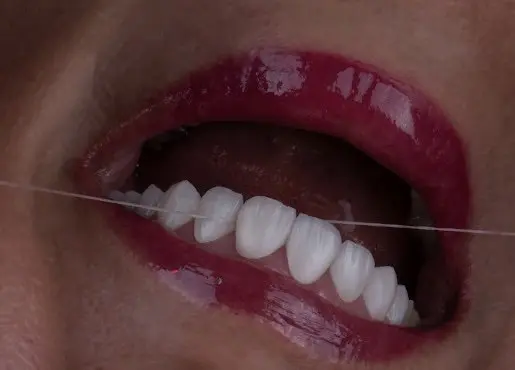 چه عواملی بر هزینه لمینت دندان تأثیرگذار است؟