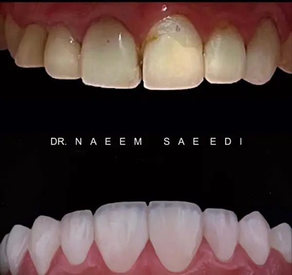 هزینه انواع لمینت دندان در تهران