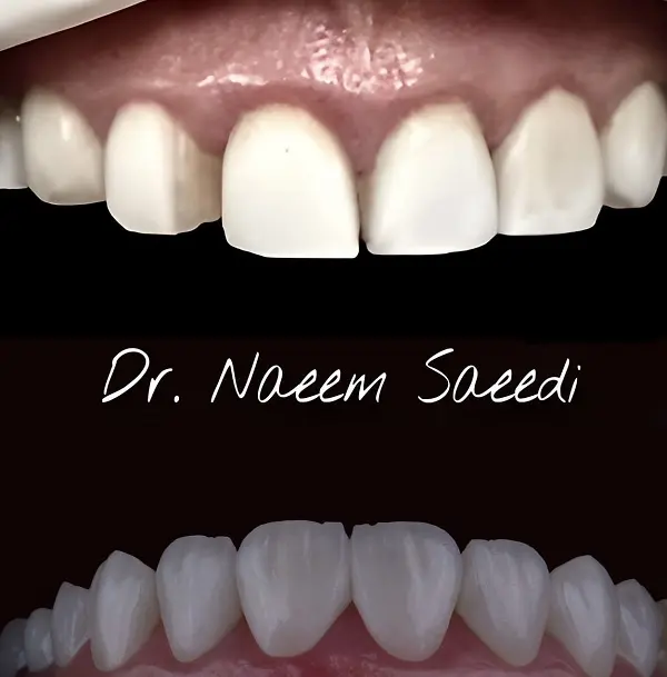 مزایای لمینت دندان اقساطی