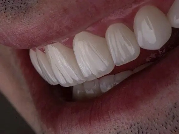 شرایط اقساط لمینت دندان چگونه است؟